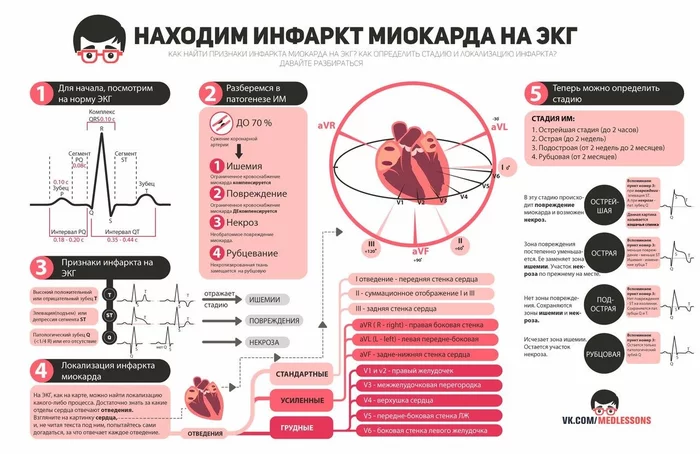 Heart attack on ECG - Heart attack, myocardial infarction, The medicine, ECG
