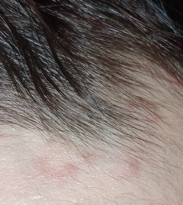 Neurodermatitis? Help - My, Disease, No rating, Dermatitis, Longpost