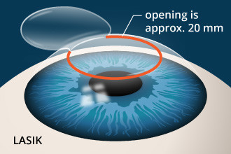 Laser vision correction - Ophthalmology, Eyes, Laser correction, Operation, Longpost