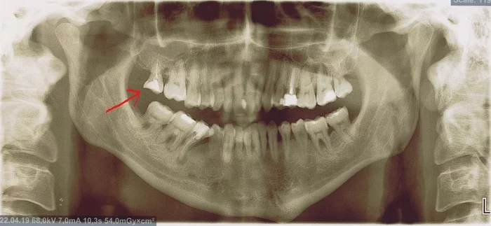 Is the tooth to blame???? - My, Dentist, Sinusitis, Teeth, Treatment, The medicine, Longpost, ENT-Doctors