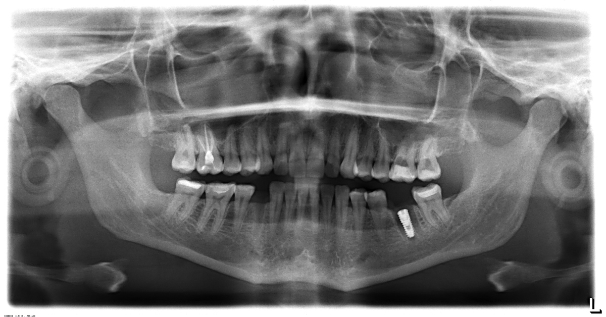 Болит зуб врач ничего не нашел thumbnail