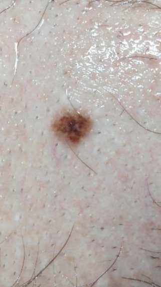 Melanoma - Cancer and oncology, Melanoma, Treatment, Mat, Longpost