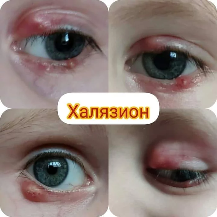 Chalazion - Chalazion, Ophthalmologist, Ophthalmology, Pediatrics, The medicine, Longpost