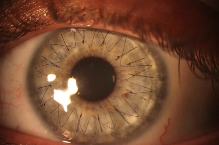 Suture after corneal transplant surgery - Eyes, Operation, Longpost