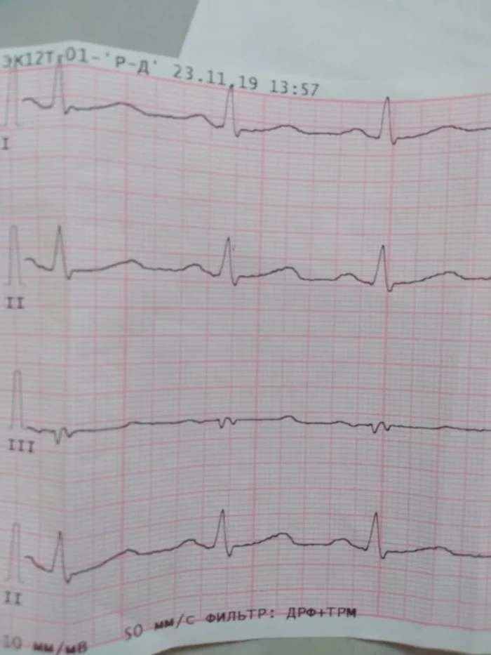 Heart attack at 37 - My, Heart attack, myocardial infarction, Longpost