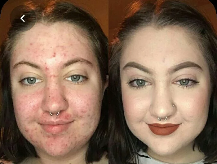 acne - Acne, Makeup, Cosmetics, Girls, Girls, , Acne, Mat