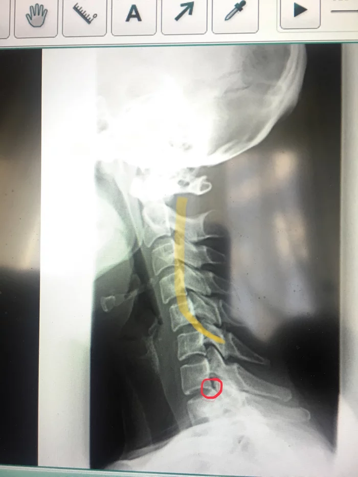 Lifelong struggle with cervical osteochondrosis) I’ll sort everything out! - My, Cervical osteochondrosis, Osteochondrosis, Treatment, Health, Longpost