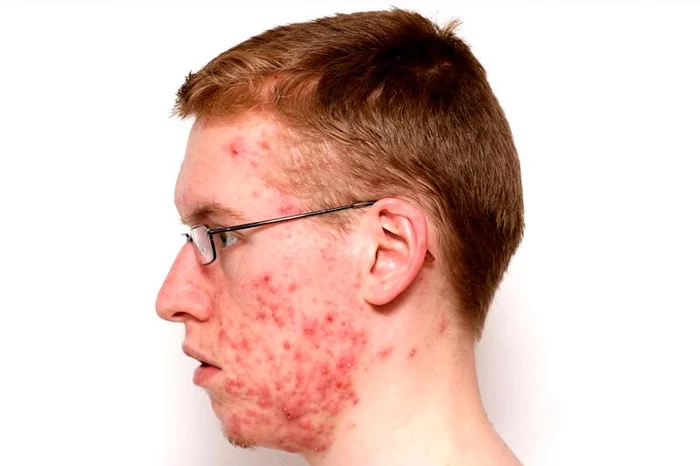 Acne, pimples, boils, scars...etc - My, Acne, Acne, Acne, Longpost
