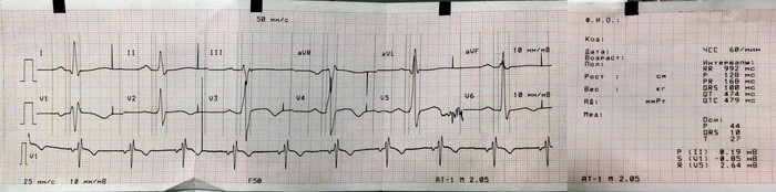 Дико извиняюсь, но я тоже со своей скучной кардиограммой Кардиология, Медицина, Сердце, ЭКГ, Длиннопост