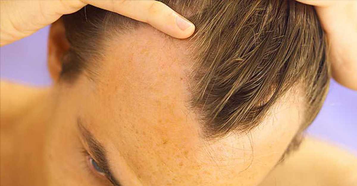 Мощный лоб. Очаговая алопеция (alopecia Areata). Лобное облысение у мужчин. Волосы на лбу у мужчин.