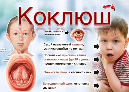 Outbreak of whooping cough. Whooping cough is close - Vaccine, Whooping cough, Vaccination, Health, Longpost