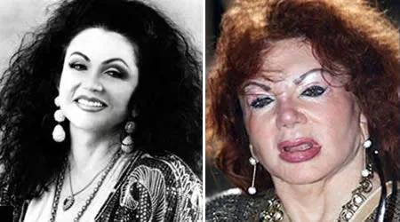 Real beauties who ruined their faces with plastic: 5 examples of celebrities - My, Celebrities, Stars, It Was-It Was, Plastic, news, Longpost, Stars