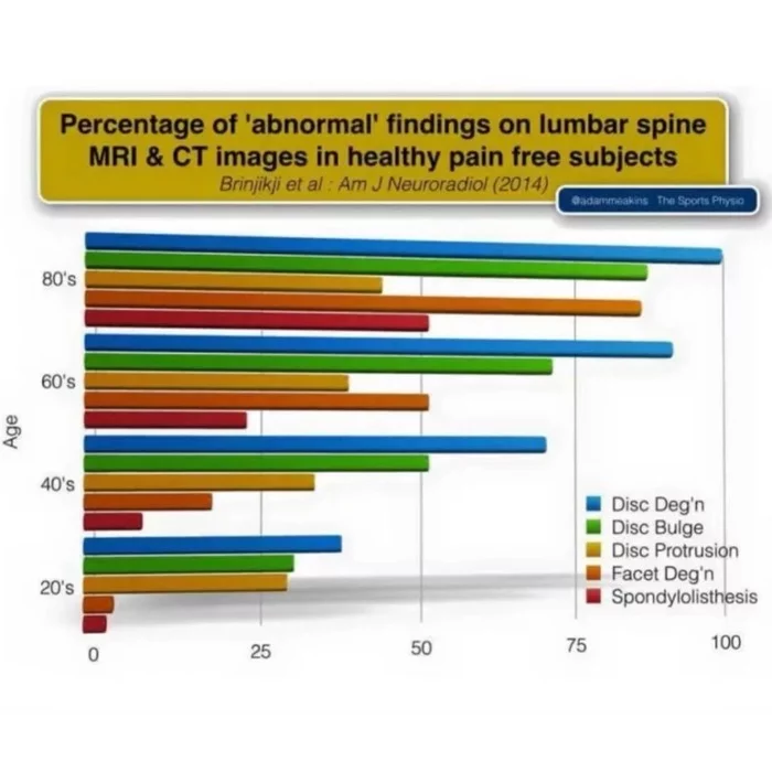 Вы - не Ваша МРТ! - Моё, Медицина, Боль, Боли в спине, Остеохондроз, Длиннопост
