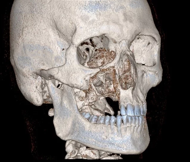 CT scan - CT, Scull, Survey, Maxillofacial Surgery