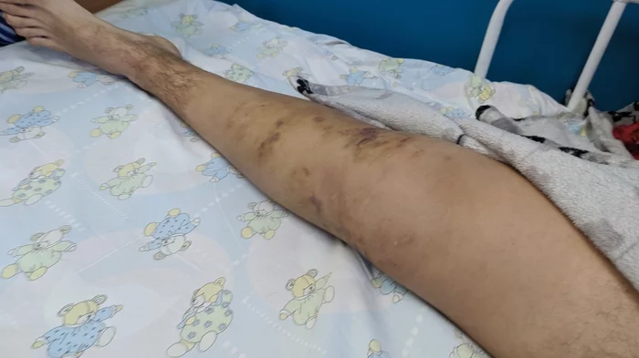 Broken leg, my story. For my birthday - My, Broken leg, Story, Longpost
