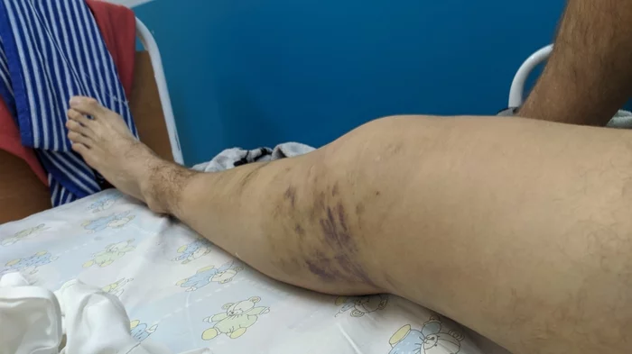 Broken leg, my story. For my birthday - My, Broken leg, Story, Longpost