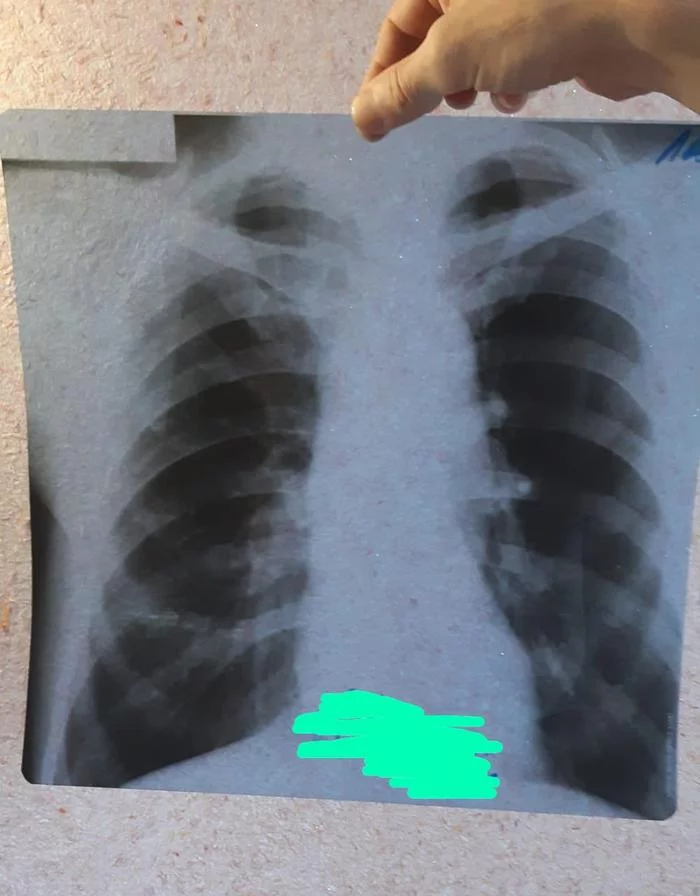 Need medical advice - My, The medicine, Need advice, X-ray, Pneumonia, No rating, Longpost