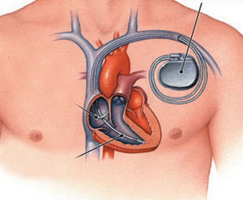 Как выглядит кардиостимулятор для сердца фото