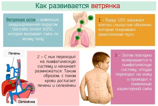 Chickenpox or chickenpox - Vaccine, Vaccination, Chickenpox, Health, Longpost