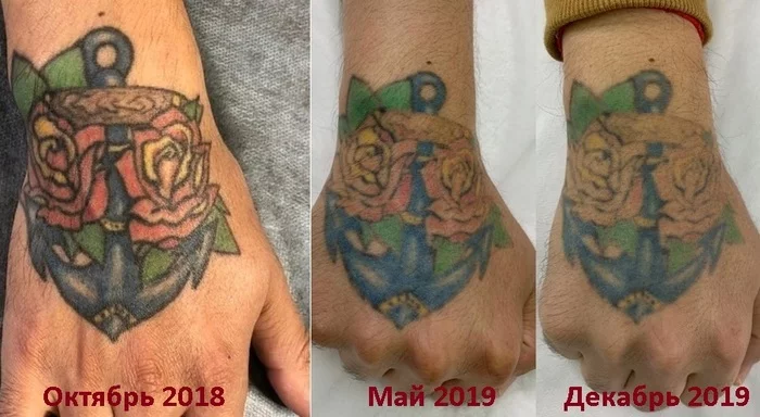 How to make a color tattoo. Generalization and preliminary summary - My, Tattoo, Tattoo removal, Laser removal, Longpost