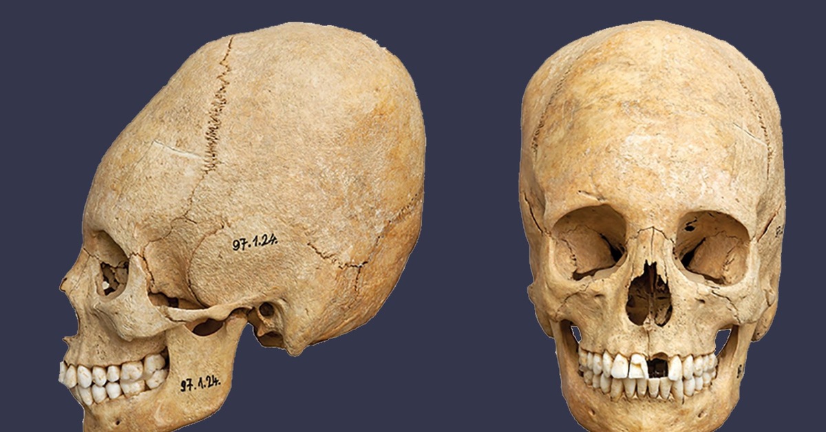 Самый древний череп человека. Деформация черепа Гунны.