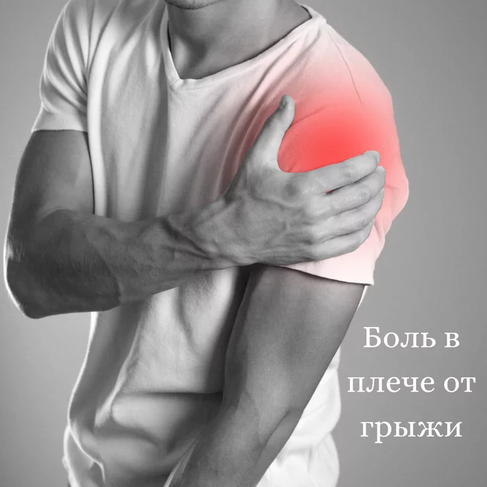 Shoulder pain from a herniated disc? It happens? - My, The science, The medicine, Health, Pain, Shoulder pain, Intervertebral hernia, Spine, Longpost