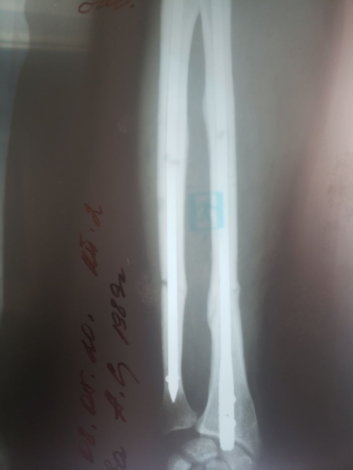 Остеосинтез костей предплечья спустя 5.5 месяцев