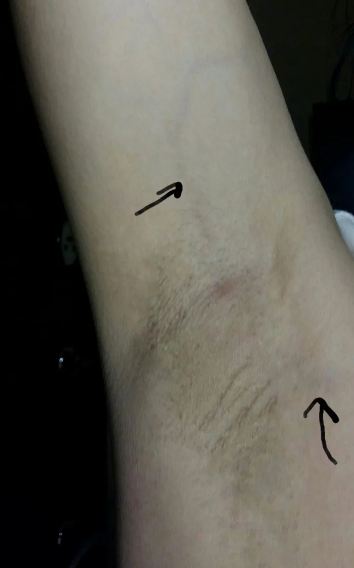 A pimple in the armpit and a purple vein popping out - My, Question, Pain, Varicose veins, Longpost