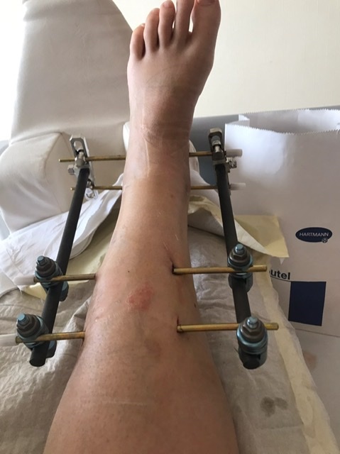 History of my first fracture - My, Broken leg, Operation, Longpost, Ilizarov apparatus