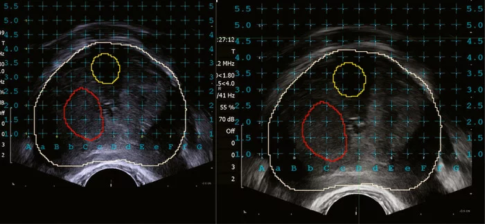 Fusion биопсия предстательной железы при подозрении на рак простаты - Моё, Рак простаты, Fusion, Рак и онкология, МРТ, Урология, Медицина, Биопсия