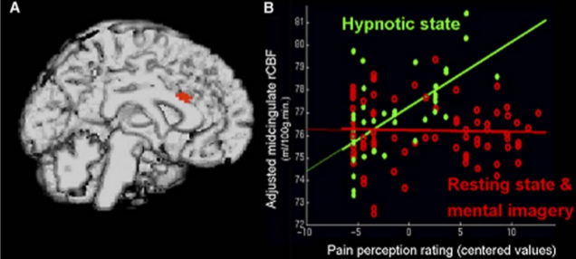 Hypnosis and neuroanotomy - Hypnosis, Psychology, Longpost