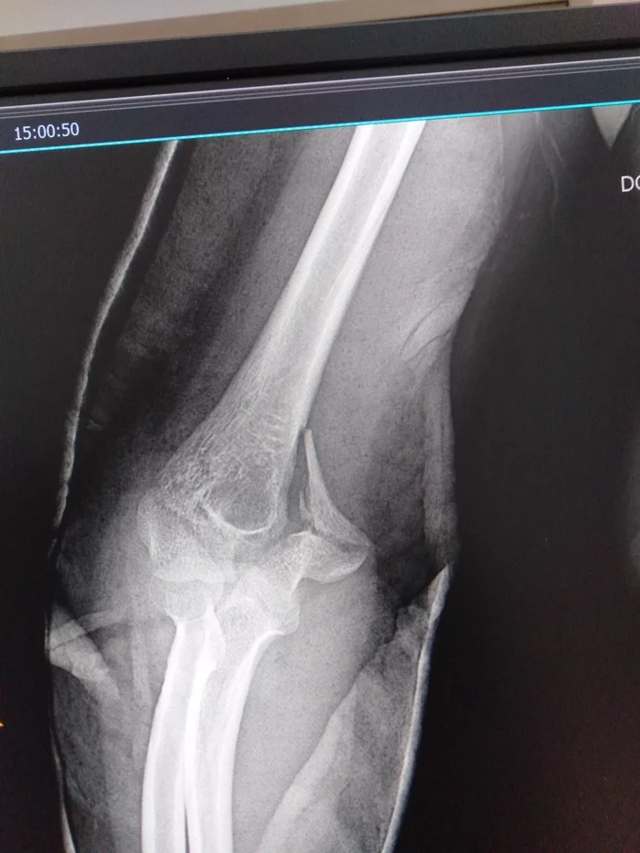 Elbow fracture - My, Fracture, X-ray, Help, Injury, Traumatology, Longpost