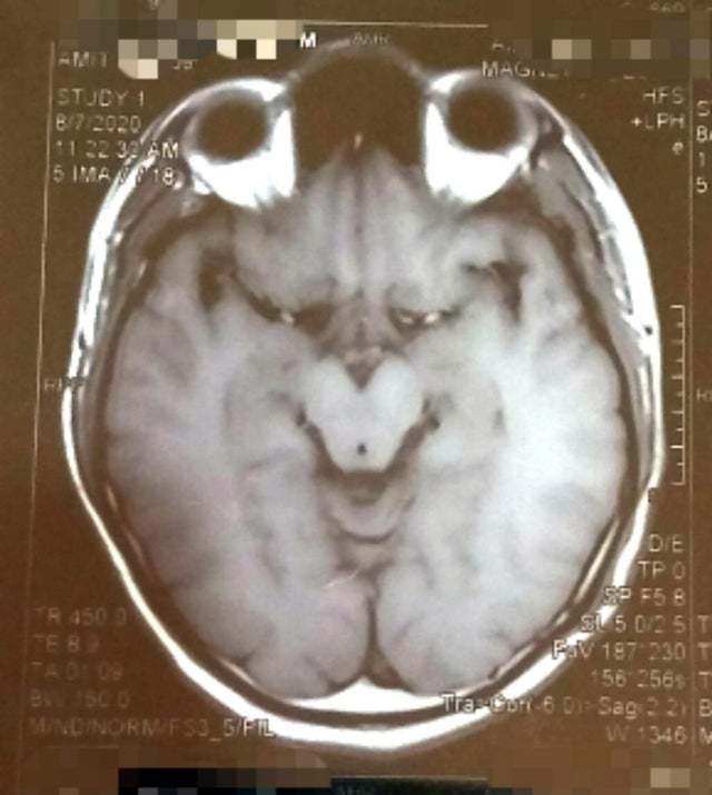 MRI of my brain looks like the Grinch - Humor, MRI, Reddit, Pareidolia, Brain, The Grinch Stole Christmas