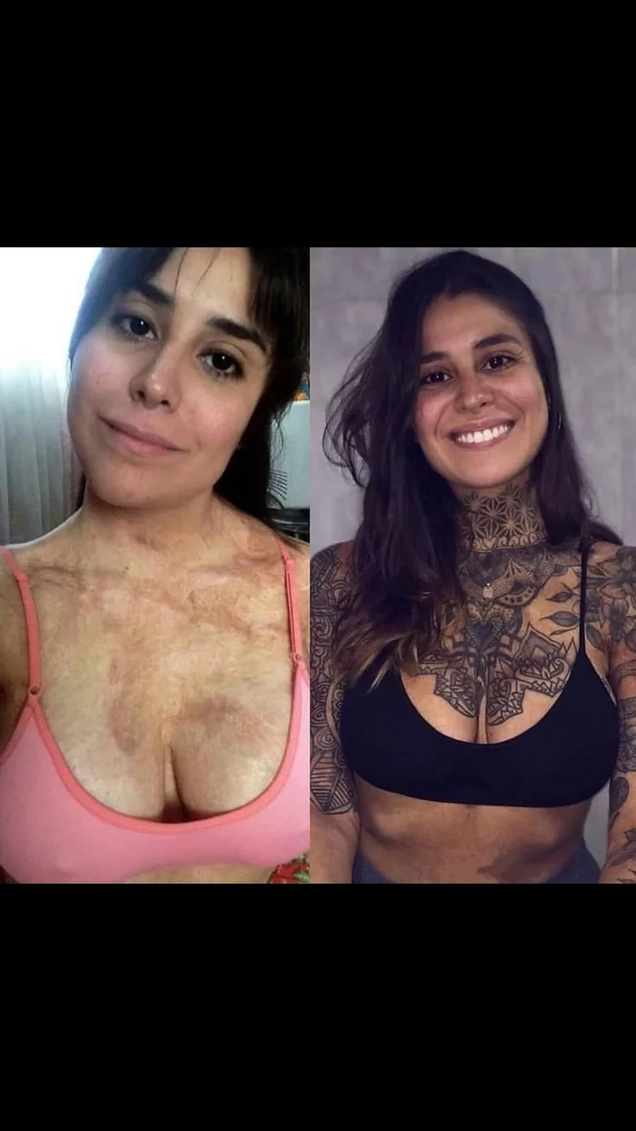 New life (left - burn, right - best tattoo application) - Tattoo, Female, Scar, Before and after, It Was-It Was, Injury, Burn, Girl with tattoo, Women