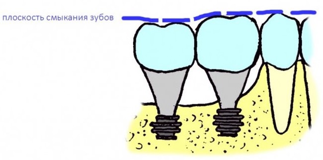 Sinus lift: how is it done? Part I - My, Dentist, Dentistry, Surgery, Implantation, Dental implantation, The medicine, Extraction of teeth, Doctors, Teeth, Doctor, Longpost, Informative