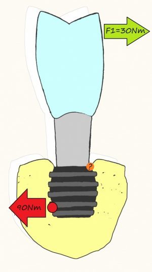 Sinus lift: how is it done? Part I - My, Dentist, Dentistry, Surgery, Implantation, Dental implantation, The medicine, Extraction of teeth, Doctors, Teeth, Doctor, Longpost, Informative