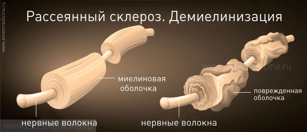 Победила склероз. Рассеянный склероз миелиновая оболочка. Миелиновая оболочка при рассеянном склерозе. Миелиновая оболочка нервных волокон головного и спинного мозга. Миелиновое нервное волокно рассеянный склероз.