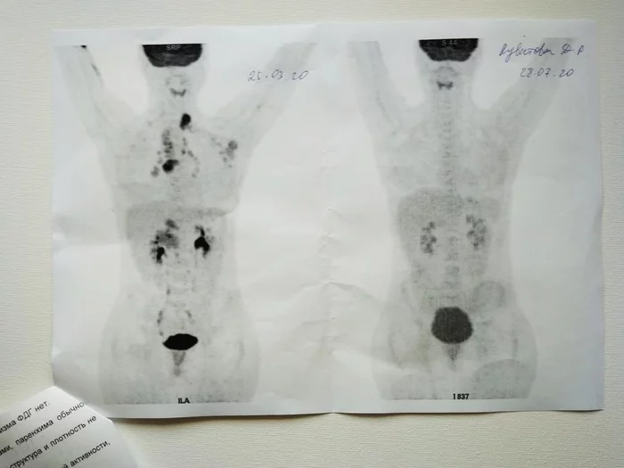 Second course - My, Hodgkin's lymphoma, Cancer and oncology, Chemotherapy, Disease history