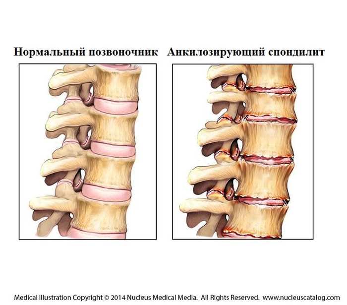 Остеофиты позвоночника шейного отдела что это такое и лечение фото