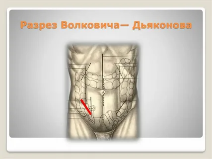 Как хирурги аппендицит лечили - Моё, Хирург, Аппендицит, Медицина, Кости, Диагностика, Длиннопост