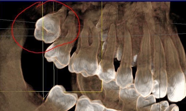 The thorny path to the dream “I want to smile without embarrassment” and why aligners - My, Orthodontics, Aligners, Braces, Invisiline, Wisdom tooth, Bite correction, GIF, Longpost