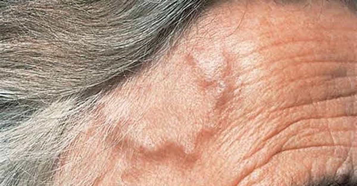 Височный артериит | Пикабу