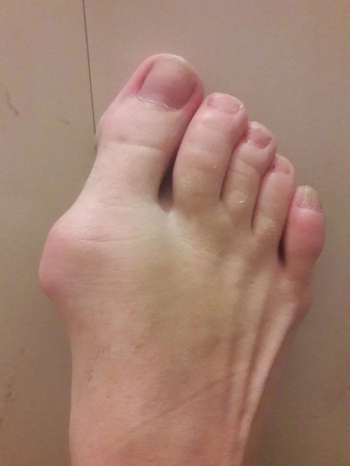 Hallux valgus or lousy bumps on the feet. History of surgical treatment and what happened in the end - My, Hallux valgus, Operation, The medicine, Legs, Longpost