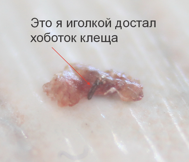 My story about how to go to the forest every 5 years and catch a tick with borreliosis in the Krasnodar Territory - Mite, Tick-borne borreliosis, Lyme disease, Краснодарский Край, Video, Longpost