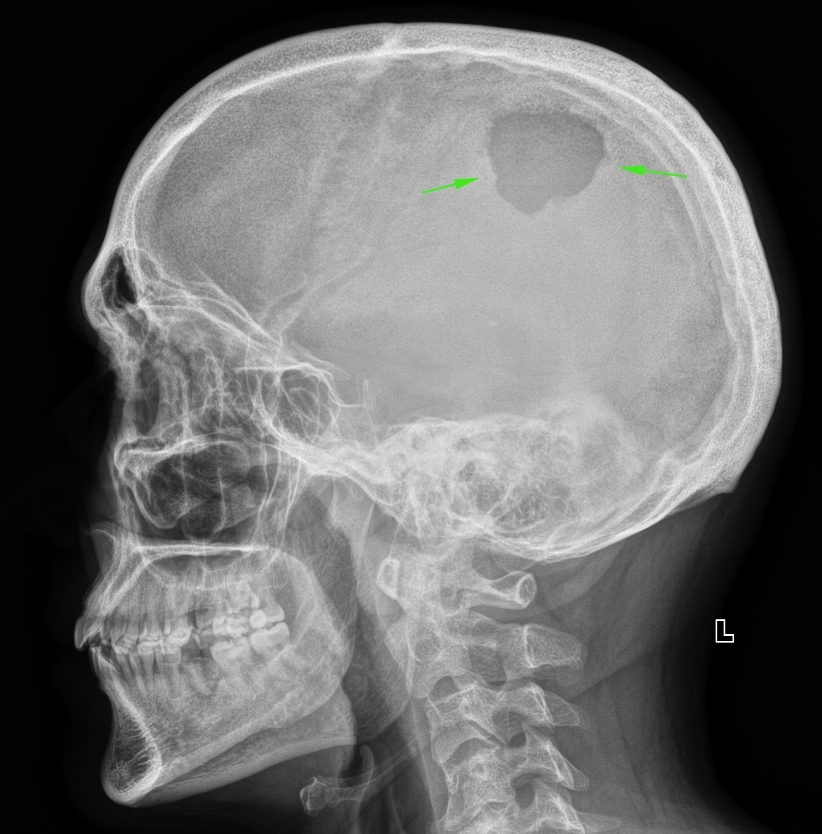 From the life of a radiologist. Part 22. Traumatic. - My, X-ray, The medicine, Longpost