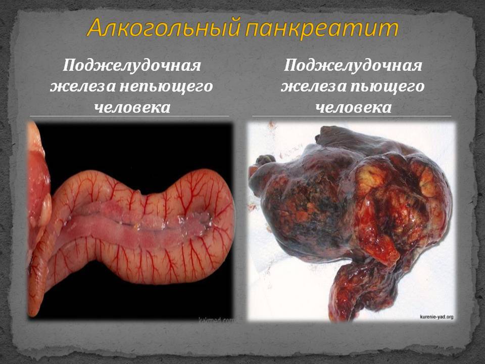 Risk factors for developing coronary artery disease or Yes, my genes are bad! - Ihd, , The medicine, Cardiology, Excess weight, Smoking, Alcoholism, Longpost, Risk