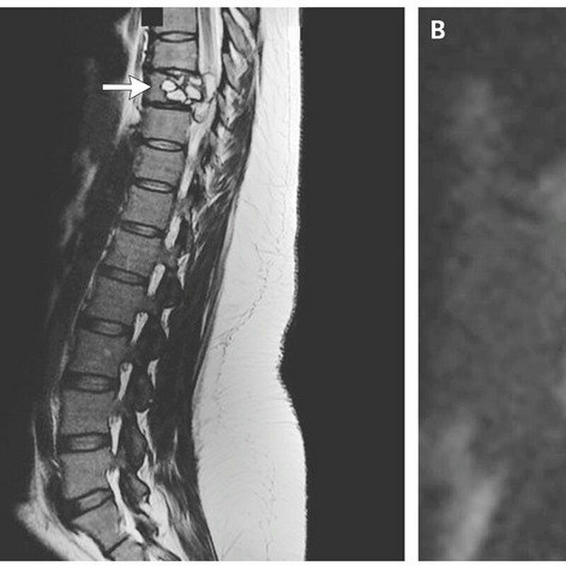 A nest of parasites has grown in the spine of a woman: a disgusting find - Disease, Shock, Female, Text, Echinococcus, Women