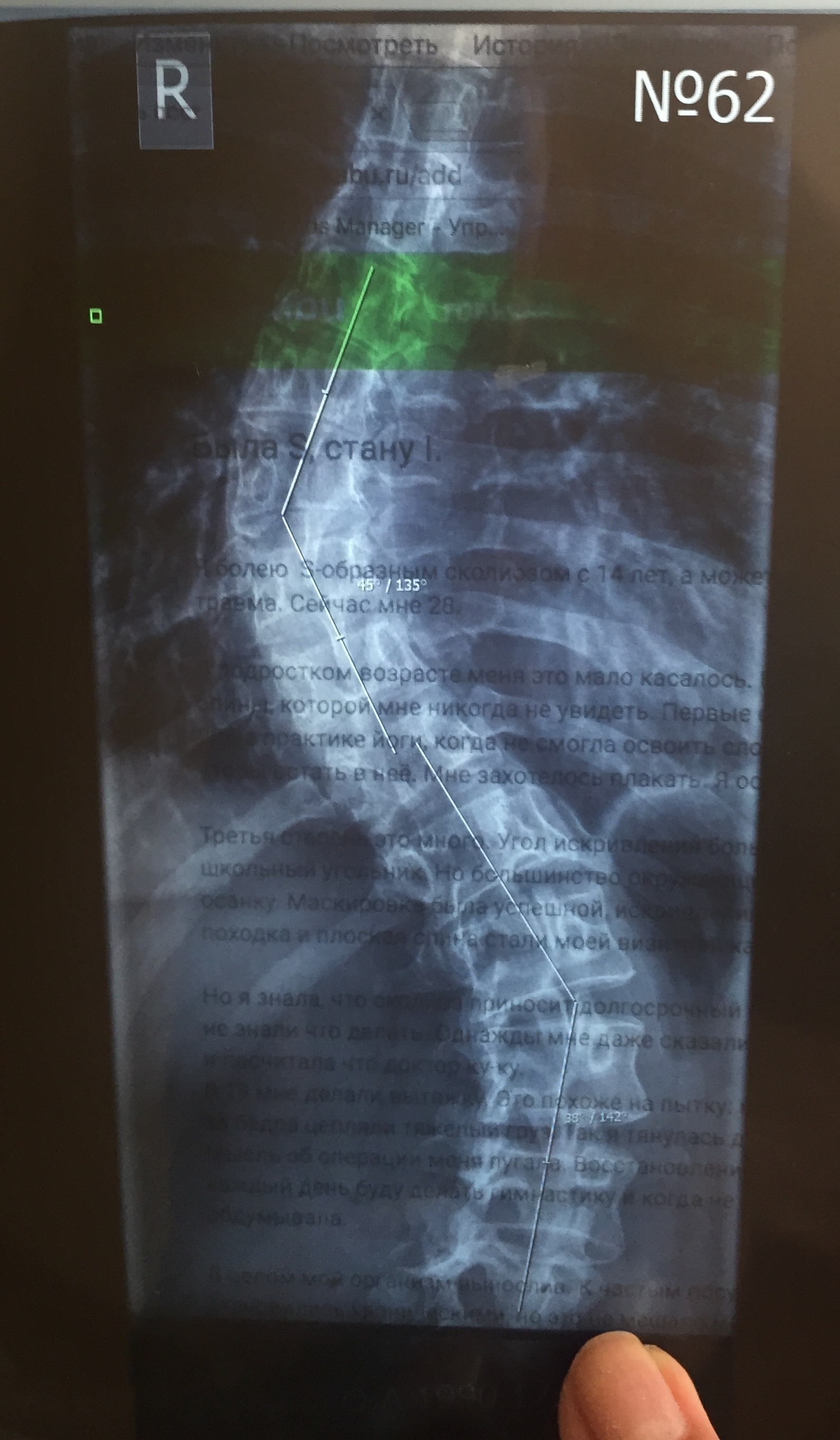 Была S, стану I. - Моё, Сколиоз, История болезни, Мотивация, Истории из жизни, Длиннопост