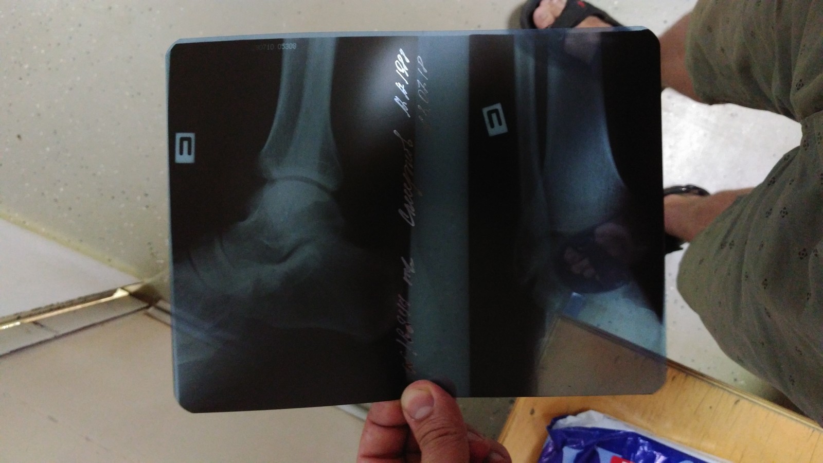 How I broke my ligaments. - My, Injury, Crutches, Gypsum, Chelyabinsk, Hospital, Longpost