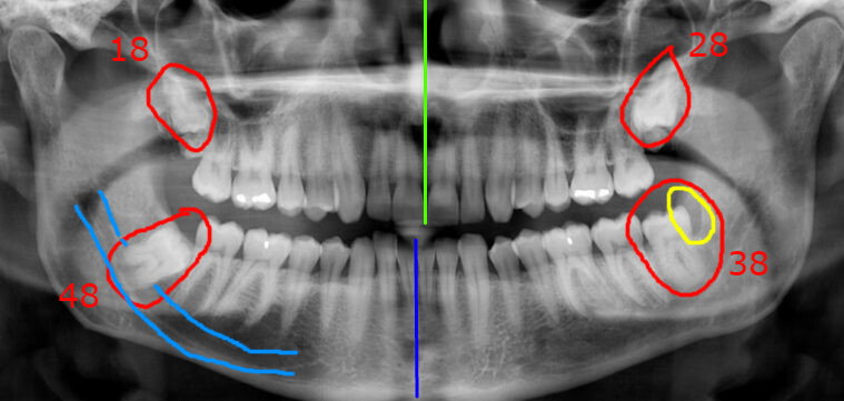 Dentistry. - My, Dentistry, The medicine, Teeth, Longpost